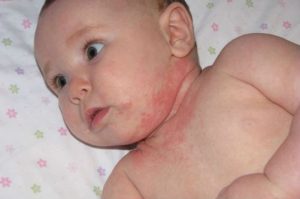 гепатит прививка новорожденным