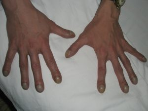 Красные руки при циррозе печени