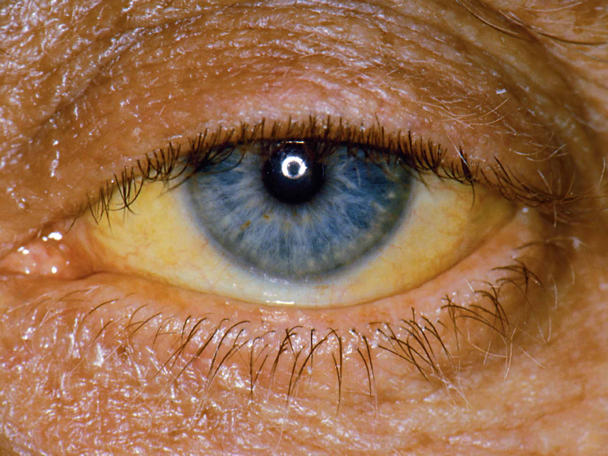 Почему у людей есть глаза. Иктеричность кожных склер. Синдром Жильбера склеры.