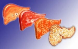 Фиброз печени