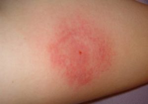 Комары не переносят вирус гепатита в