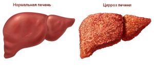 Влияние гепатита на щитовидную железу