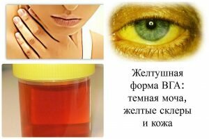Симптомы и лечение гепатита А