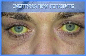 Как лечить гепатит?